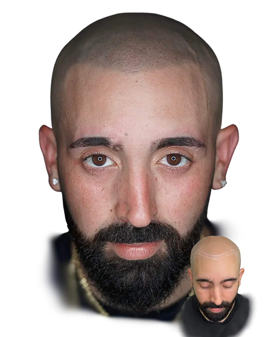 Healed scalp micropigmentation by Stevey G, matched to the beard, real client, before shown inset