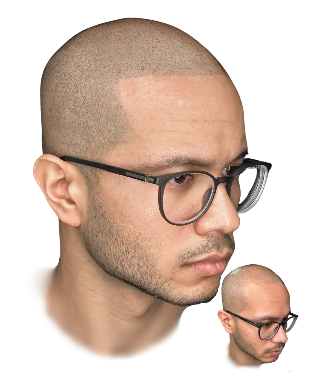Healed scalp micropigmentation by Stevey G, the profile line, real client, before shown inset