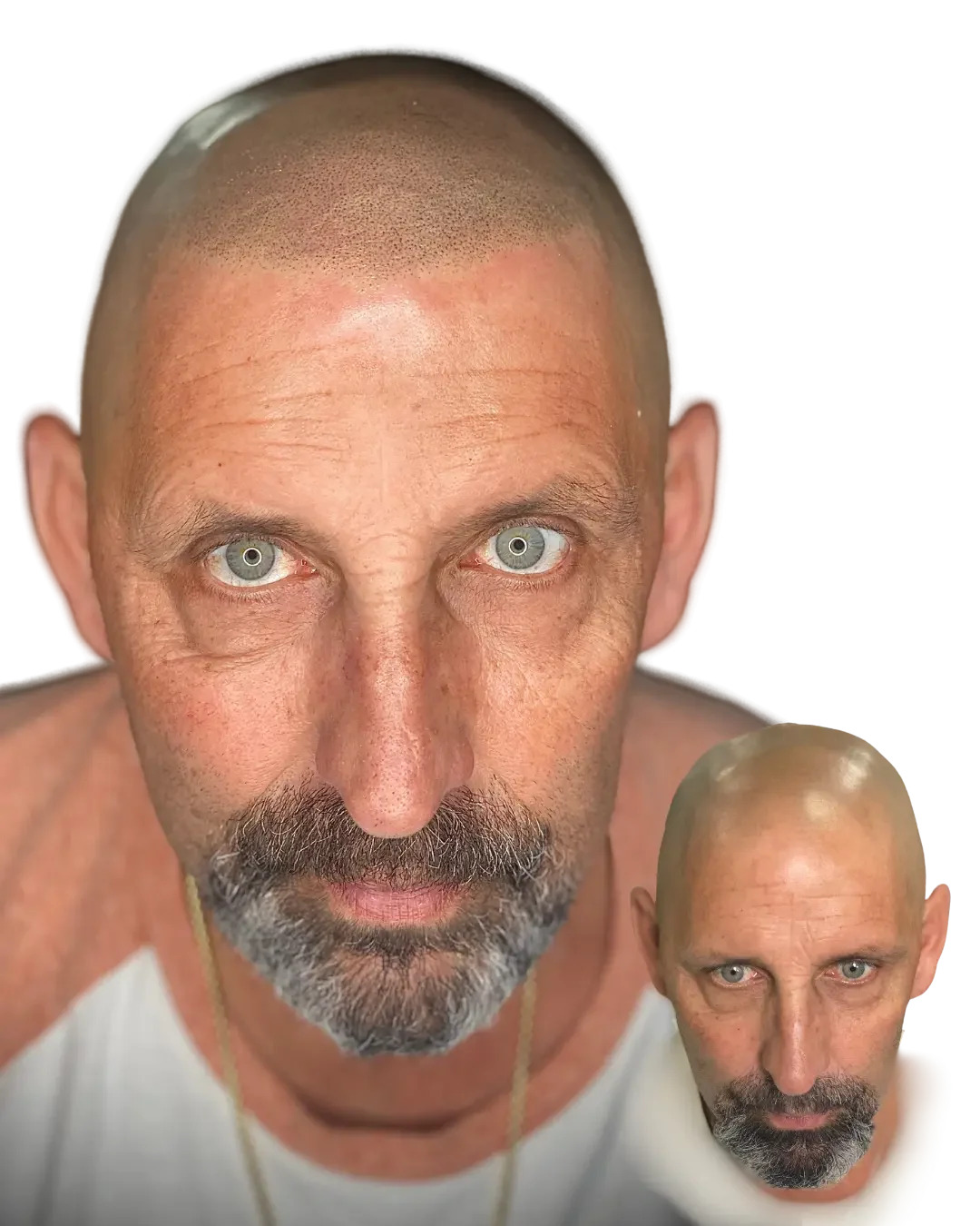 Healed scalp micropigmentation by Stevey G, density into grey, real client, before shown inset