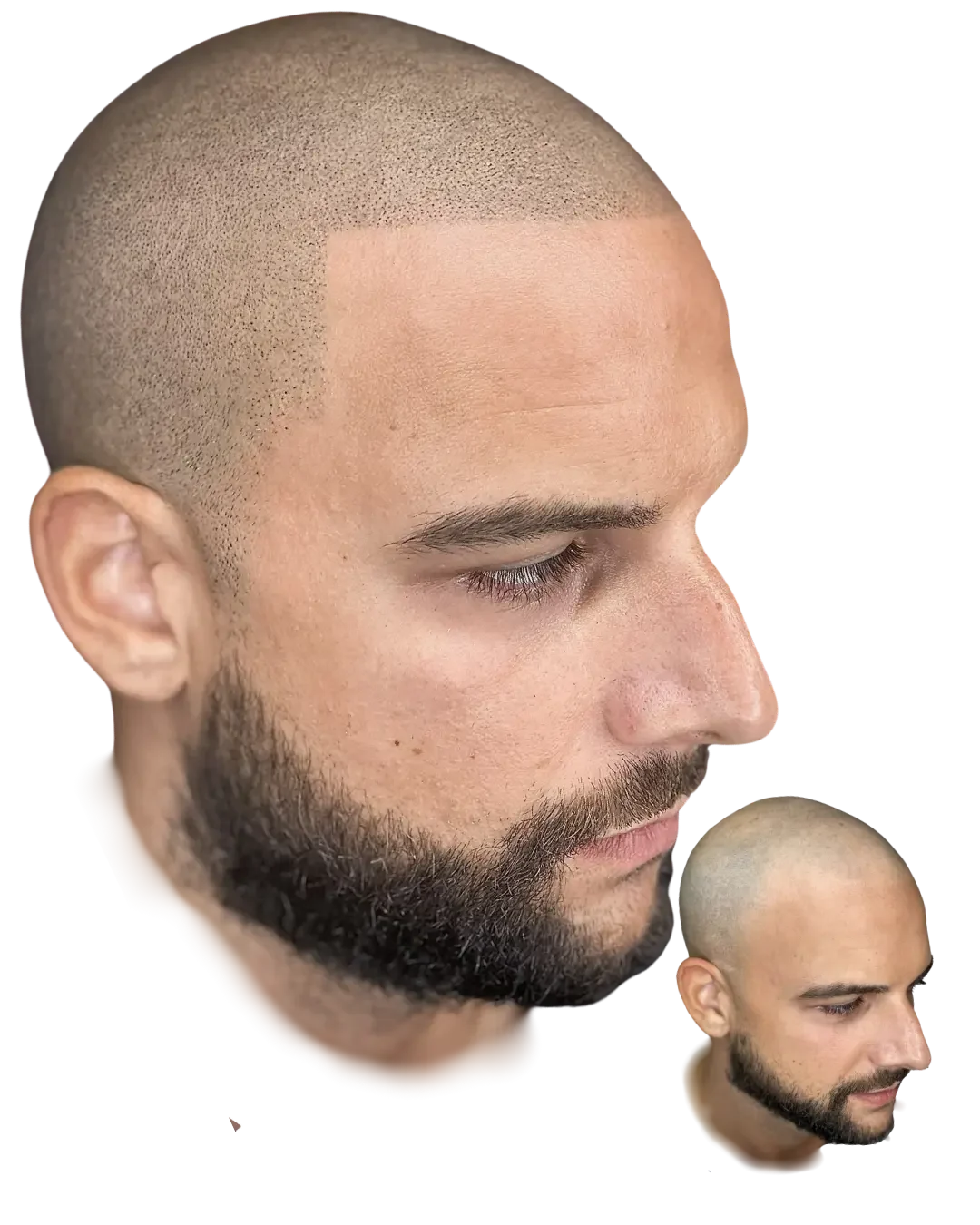 Healed scalp micropigmentation by Stevey G, temple and side, real client, before shown inset