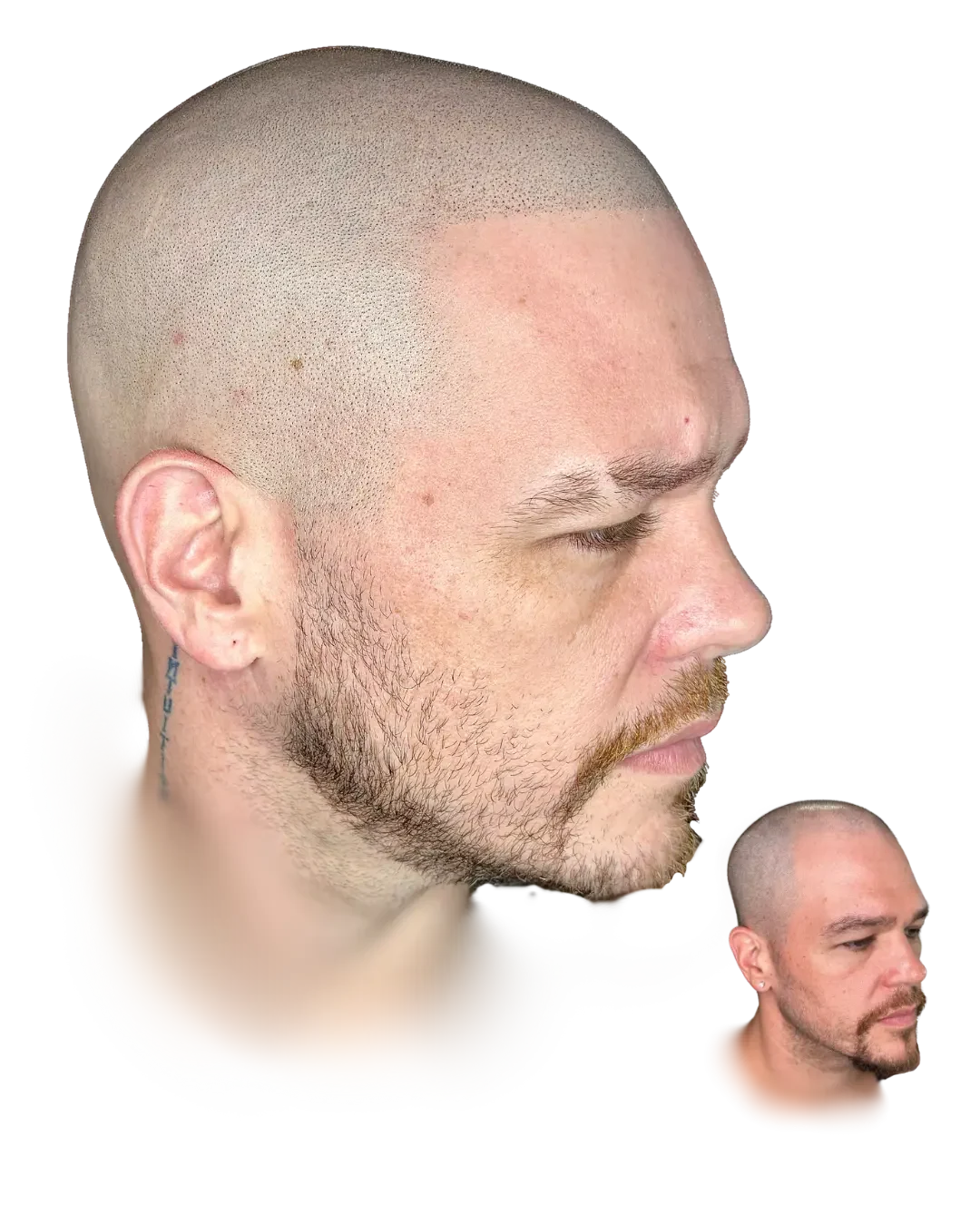 Healed scalp micropigmentation by Stevey G, recession closed, real client, before shown inset